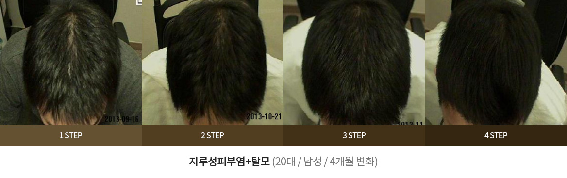 지루성피부염+탈모 (20대 / 남성 / 4개월 변화)